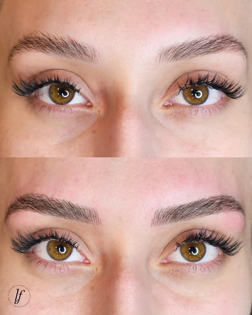 Antes e depois de micropigmentação de sobrancelhas, caso 01, atendido por Livia First