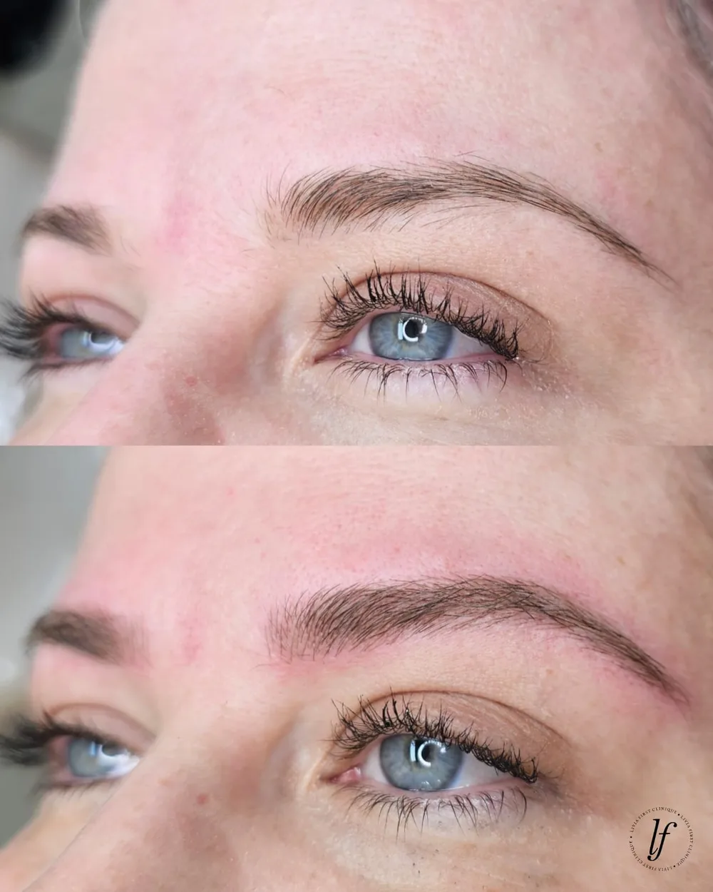 Antes e depois de micropigmentação de sobrancelhas, caso 03, atendido por Livia First