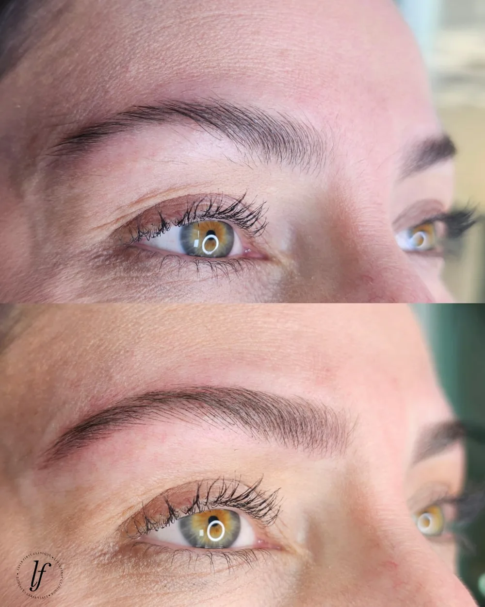 Antes e depois de micropigmentação de sobrancelhas, caso 05, atendido por Livia First
