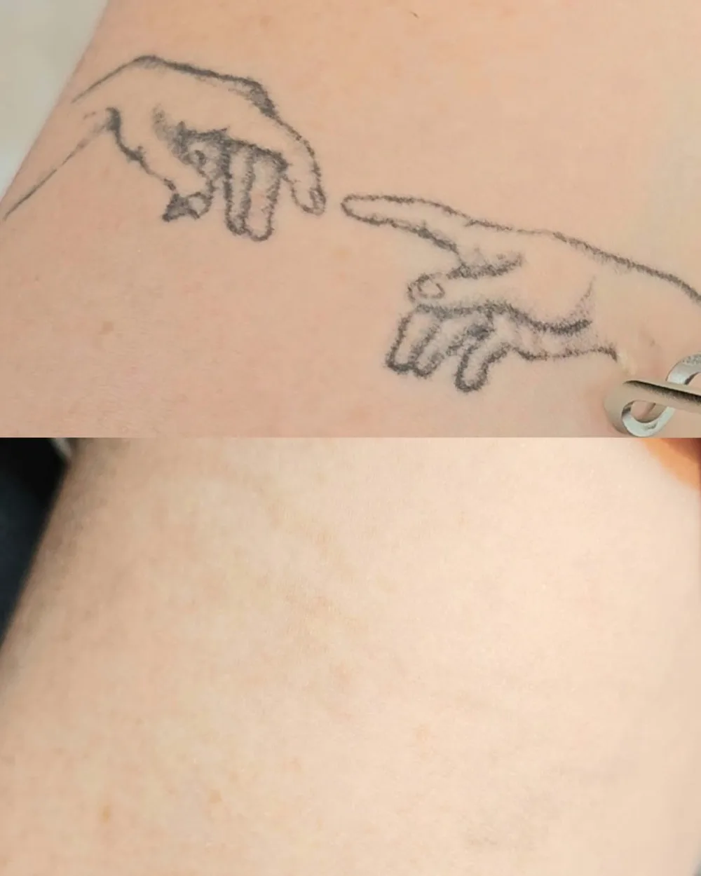 Antes e depois de despigmentação a laser, caso 01, atendido por Livia First