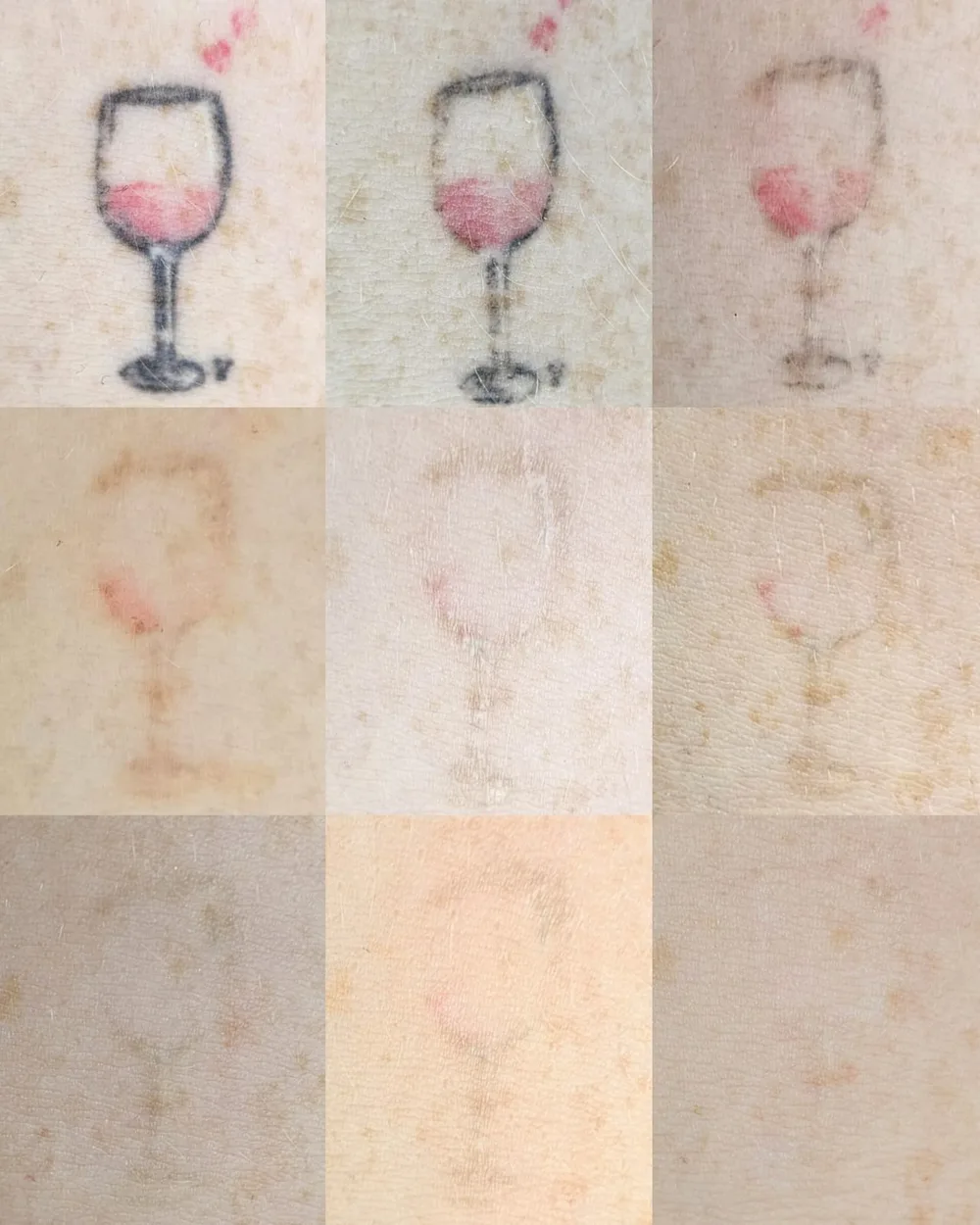 Antes e depois de despigmentação a laser, caso 05, atendido por Livia First