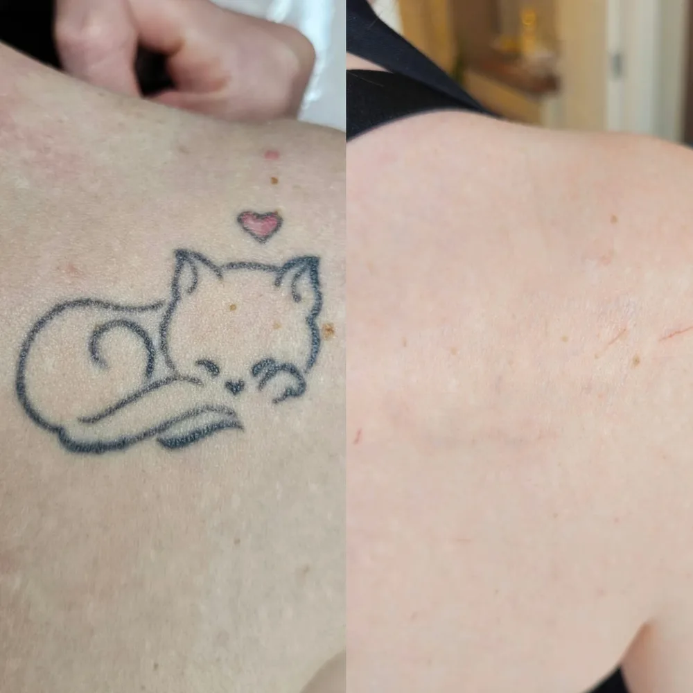 Antes e depois de despigmentação a laser, caso 07, atendido por Livia First