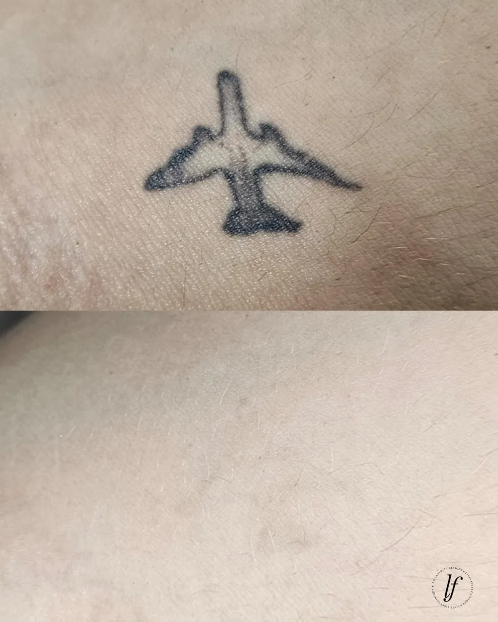 Antes e depois de despigmentação a laser, caso 03, atendido por Livia First