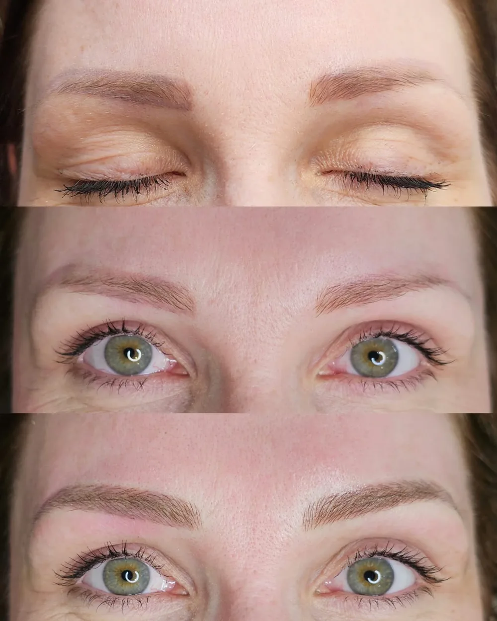 Antes e depois de despigmentação a laser, caso 02, atendido por Livia First