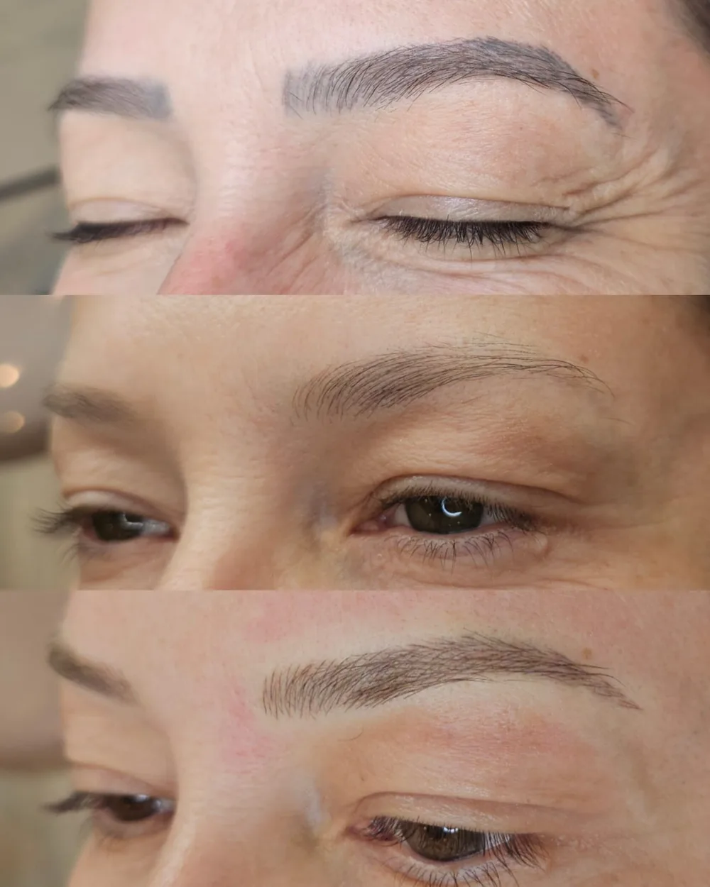 Antes e depois de despigmentação a laser, caso 06, atendido por Livia First