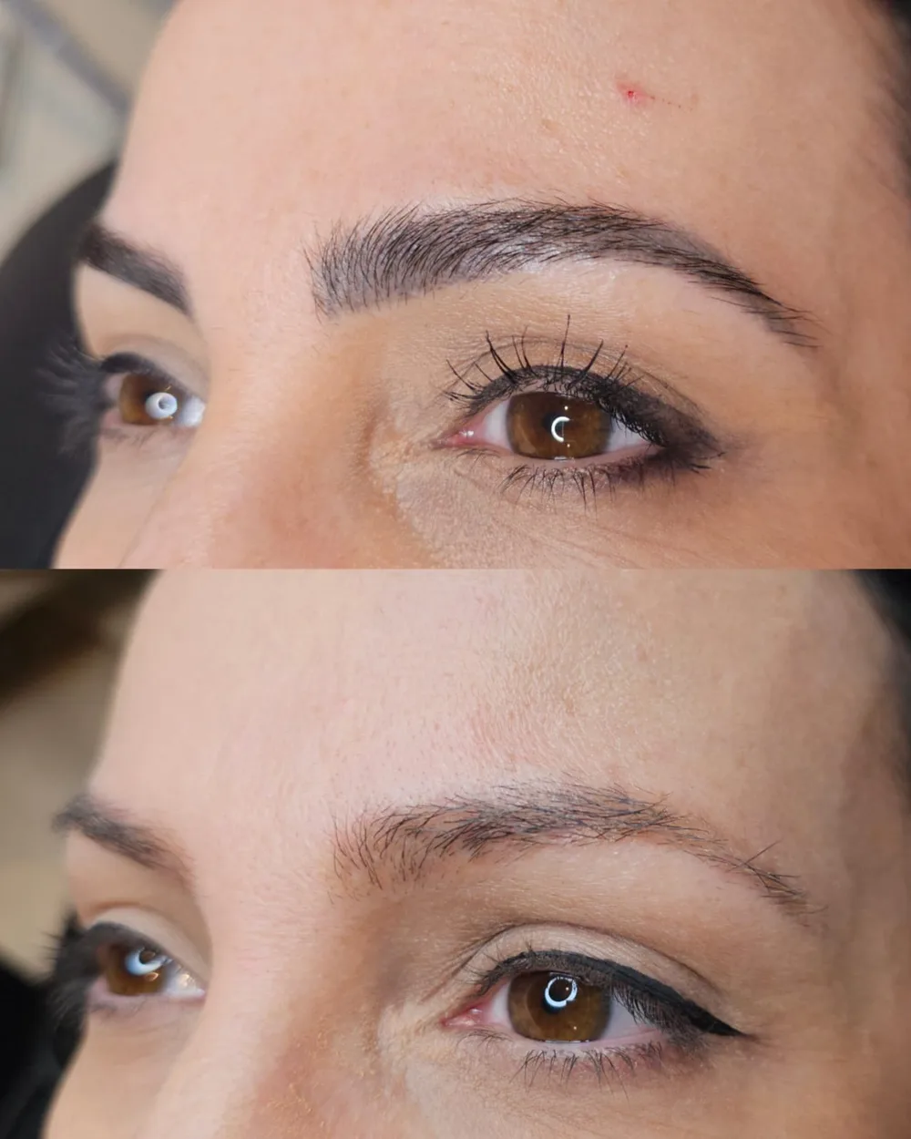 Antes e depois de despigmentação a laser, caso 04, atendido por Livia First