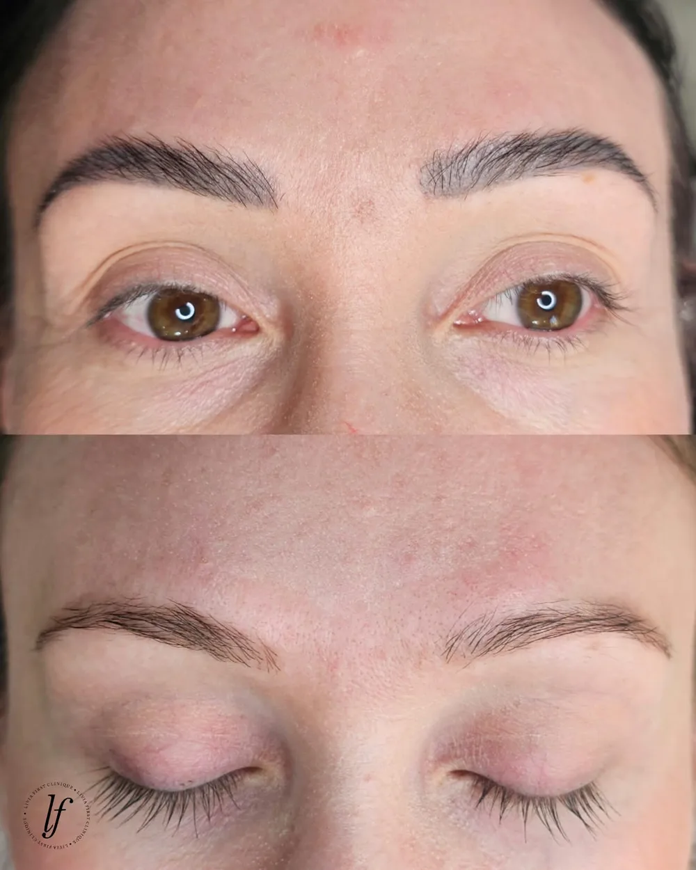 Antes e depois de despigmentação a laser, caso 08, atendido por Livia First
