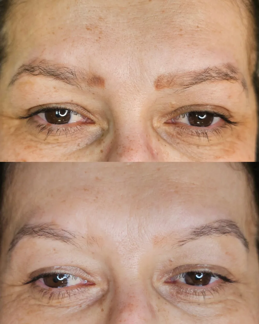 Antes e depois de despigmentação a laser, caso 09, atendido por Livia First