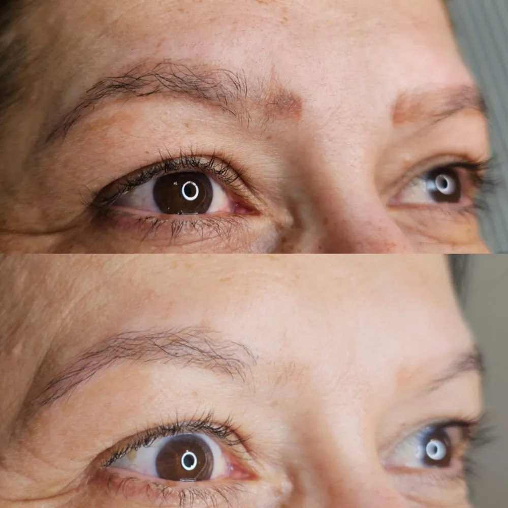 Antes e depois de despigmentação a laser, caso 10, atendido por Livia First